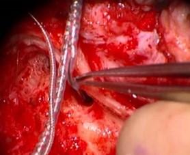 Cochlear Implant Surgery